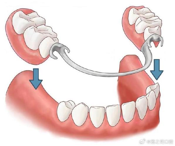 拥挤牙齿结扎的有效方法有哪些？详细操作步骤是怎样的？-图1