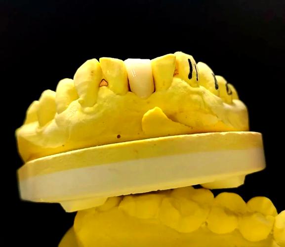 种牙后做的马里兰桥-图1 种牙后做的马里兰桥-图1