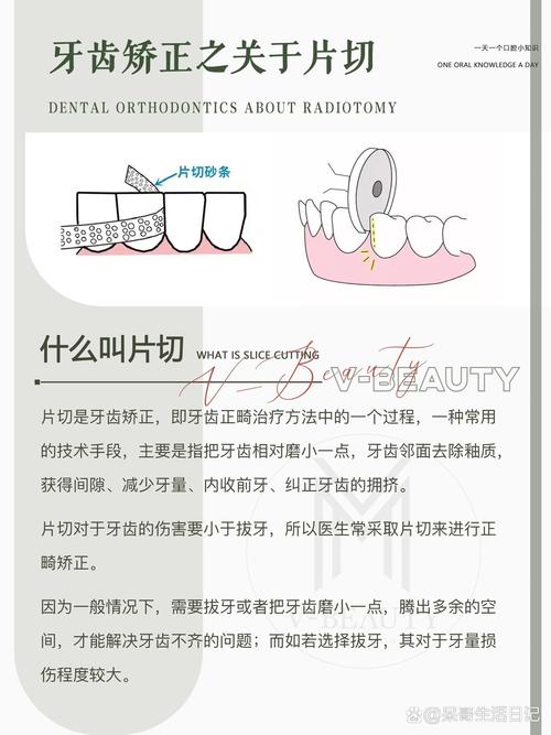 正畸片切需要多长时间完成?-图2 正畸片切需要多长时间完成?-图2