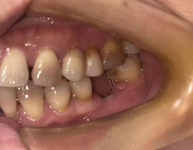 正畸后一颗尖牙老不动-图2