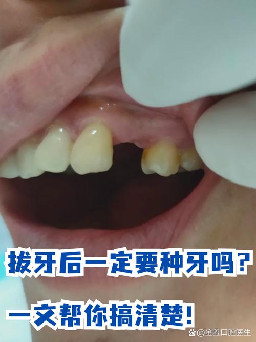 拔牙5年后,还能成功种牙吗?-图2 拔牙5年后,还能成功种牙吗?-图2