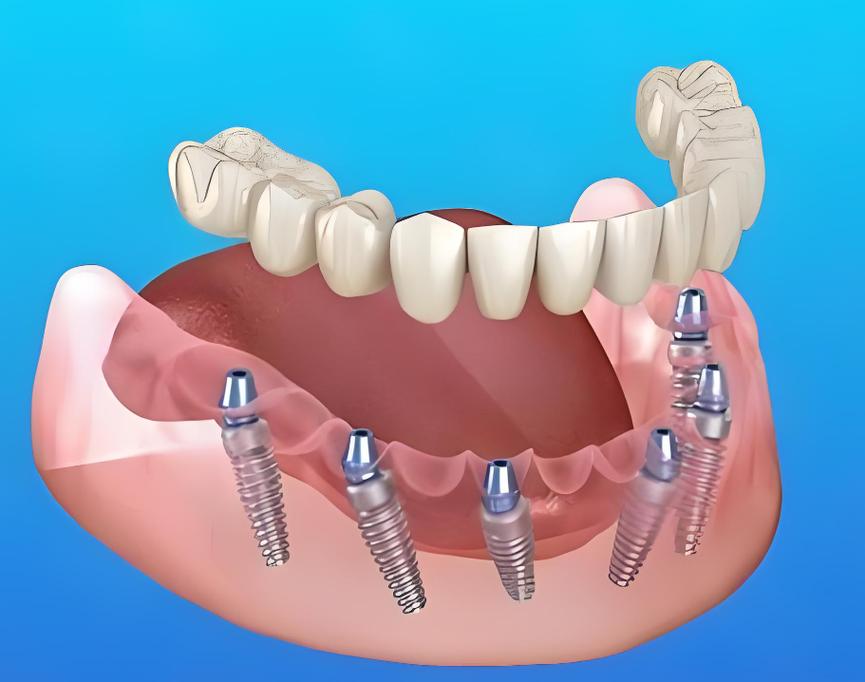 数字化种牙月朋友圈刷屏,效果真的这么好吗?-图3 数字化种牙月朋友圈刷屏,效果真的这么好吗?-图3
