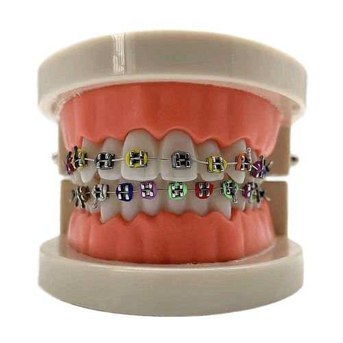 陶瓷托槽矫正最好方法-图1 陶瓷托槽矫正最好方法-图1