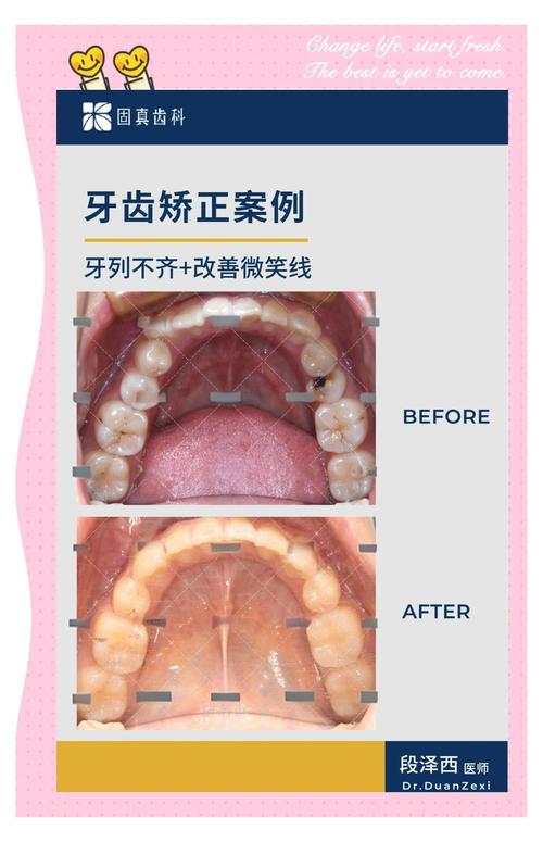牙槽骨突出手术和正畸,该先做哪个?效果如何?-图2 牙槽骨突出手术和正畸,该先做哪个?效果如何?-图2