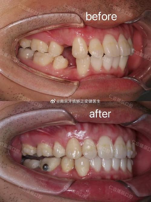 正畸拔三颗牙的原因是什么?案例图片看懂这些治疗关键点-图1 正畸拔三颗牙的原因是什么?案例图片看懂这些治疗关键点-图1