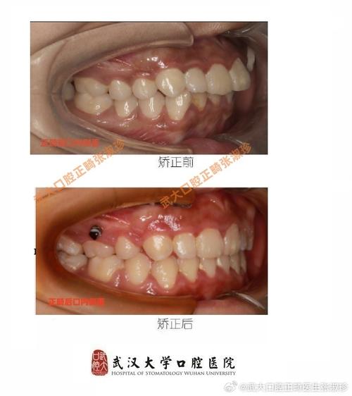 正畸拔三颗牙的原因是什么？案例图片看懂这些治疗关键点-图2