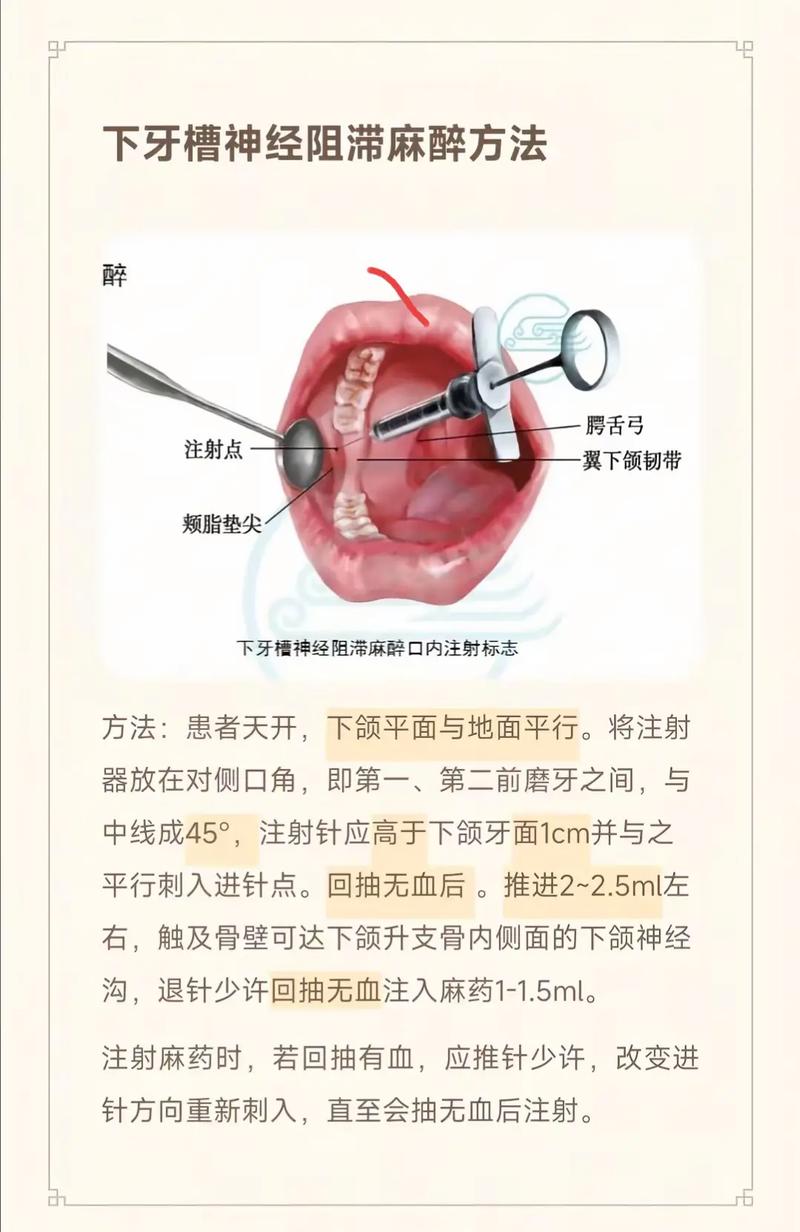 口腔阻滞麻醉常用方法有哪些?不同部位的麻醉技巧与注意事项是什么?-图1 口腔阻滞麻醉常用方法有哪些?不同部位的麻醉技巧与注意事项是什么?-图1