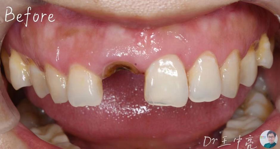 20年前种的牙植体-图3