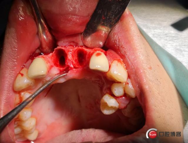 20年前种的牙植体-图2