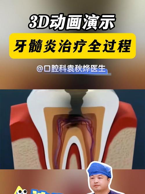 青少年牙髓炎治疗有哪些方法?如何选择兼顾发育与疗效?-图3 青少年牙髓炎治疗有哪些方法?如何选择兼顾发育与疗效?-图3