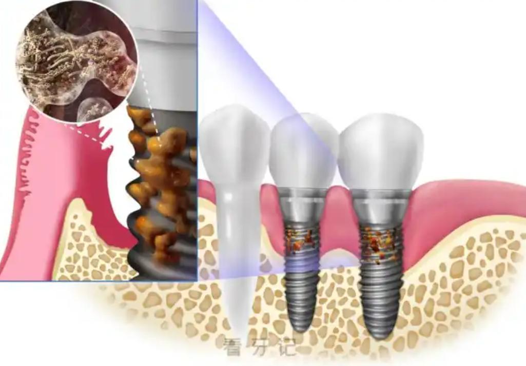 种牙第一期失败原因-图3