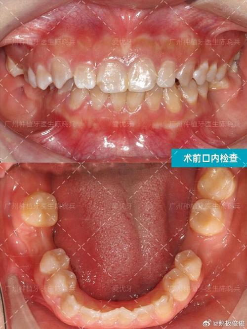 种牙一期后牙槽骨薄-图1 种牙一期后牙槽骨薄-图1