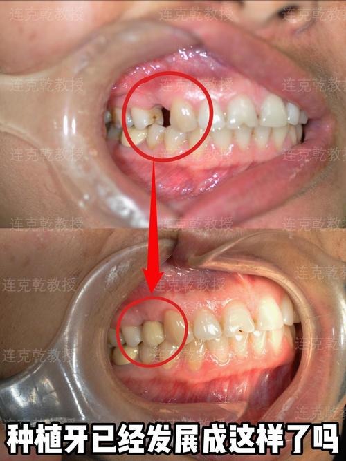 种牙一期后牙槽骨薄-图2 种牙一期后牙槽骨薄-图2