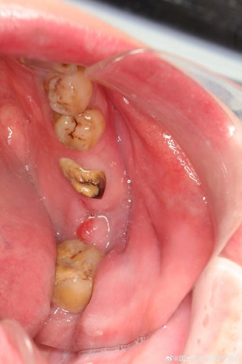 种牙一期后牙槽骨薄-图3 种牙一期后牙槽骨薄-图3