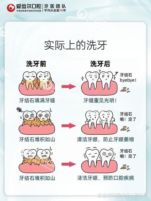 去牙结石最有效的方法-图2 去牙结石最有效的方法-图2