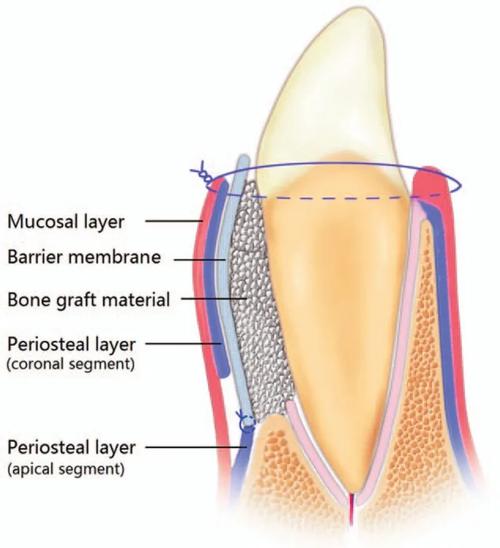 牙周加速骨源性正畸学-图1 牙周加速骨源性正畸学-图1