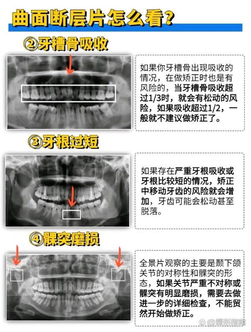 牙周加速骨源性正畸学-图2 牙周加速骨源性正畸学-图2