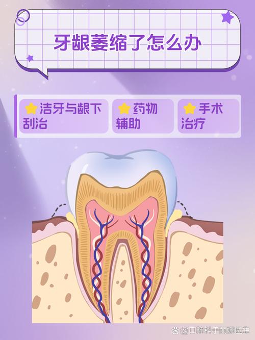 牙龈萎缩手术治疗方法-图2 牙龈萎缩手术治疗方法-图2
