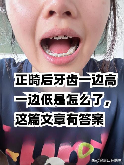 正畸过程中牙齿会龅吗-图3