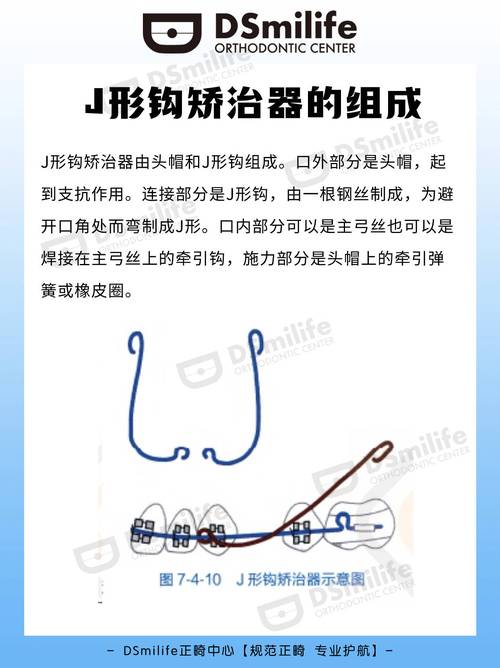 正畸方丝牵引钩如何装-图1