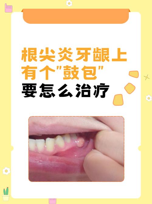 牙根发炎怎么办?治疗方法有哪些?-图3 牙根发炎怎么办?治疗方法有哪些?-图3