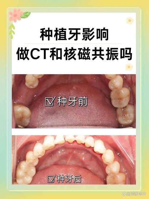 种植牙如何选择材料与安装方式才能不影响核磁共振检查?-图2 种植牙如何选择材料与安装方式才能不影响核磁共振检查?-图2
