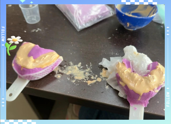 种牙取模型两种方法，各有何优缺点？-图3