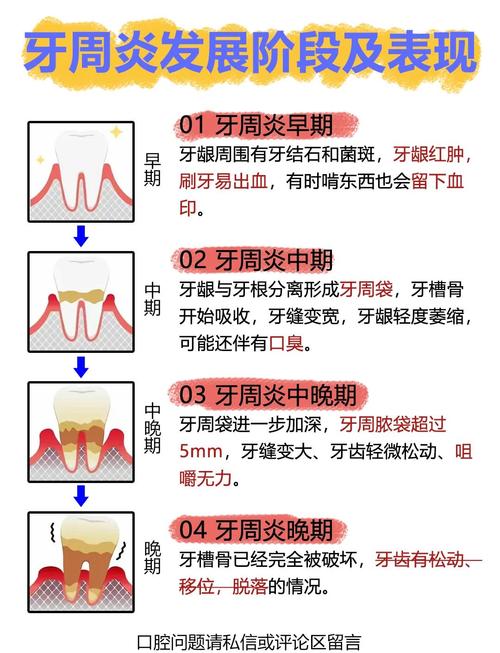严重牙周炎的治疗方法-图1 严重牙周炎的治疗方法-图1