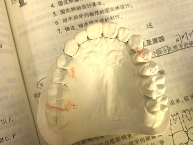 老人牙齿松动固定方法-图1 老人牙齿松动固定方法-图1