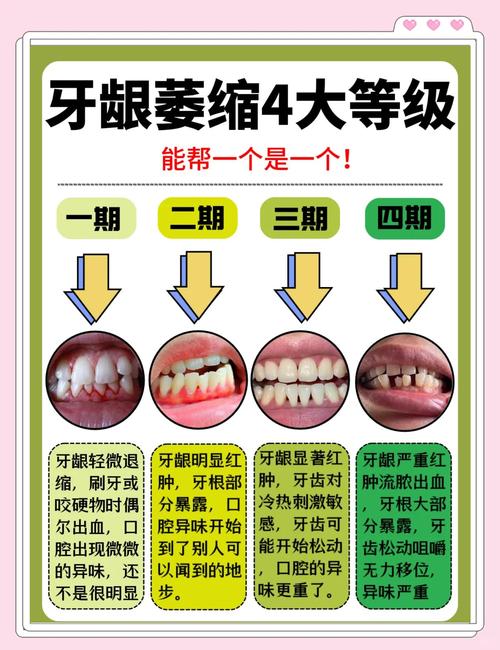 牙龈萎缩去医院治疗有哪些常用的专业治疗方法?-图3 牙龈萎缩去医院治疗有哪些常用的专业治疗方法?-图3