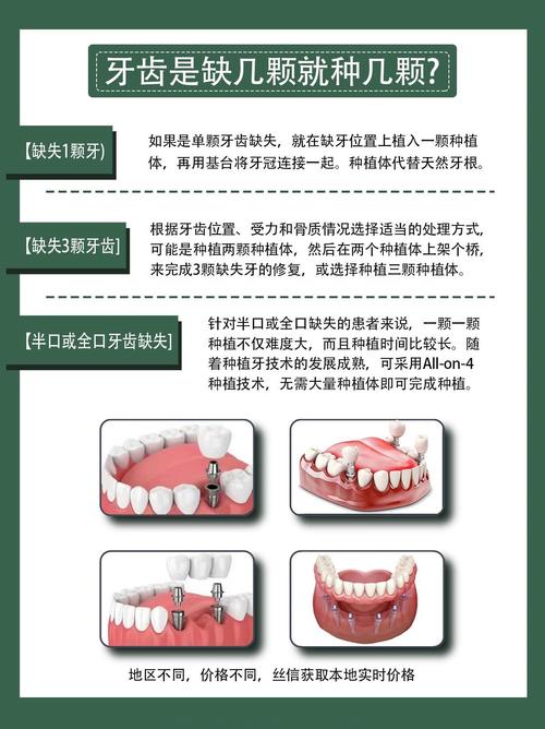 缺一颗牙需要种几颗-图1 缺一颗牙需要种几颗-图1