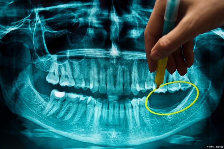 儿童牙齿CT检查的具体方法有哪些？不同检查方式的区别与注意事项？-图3