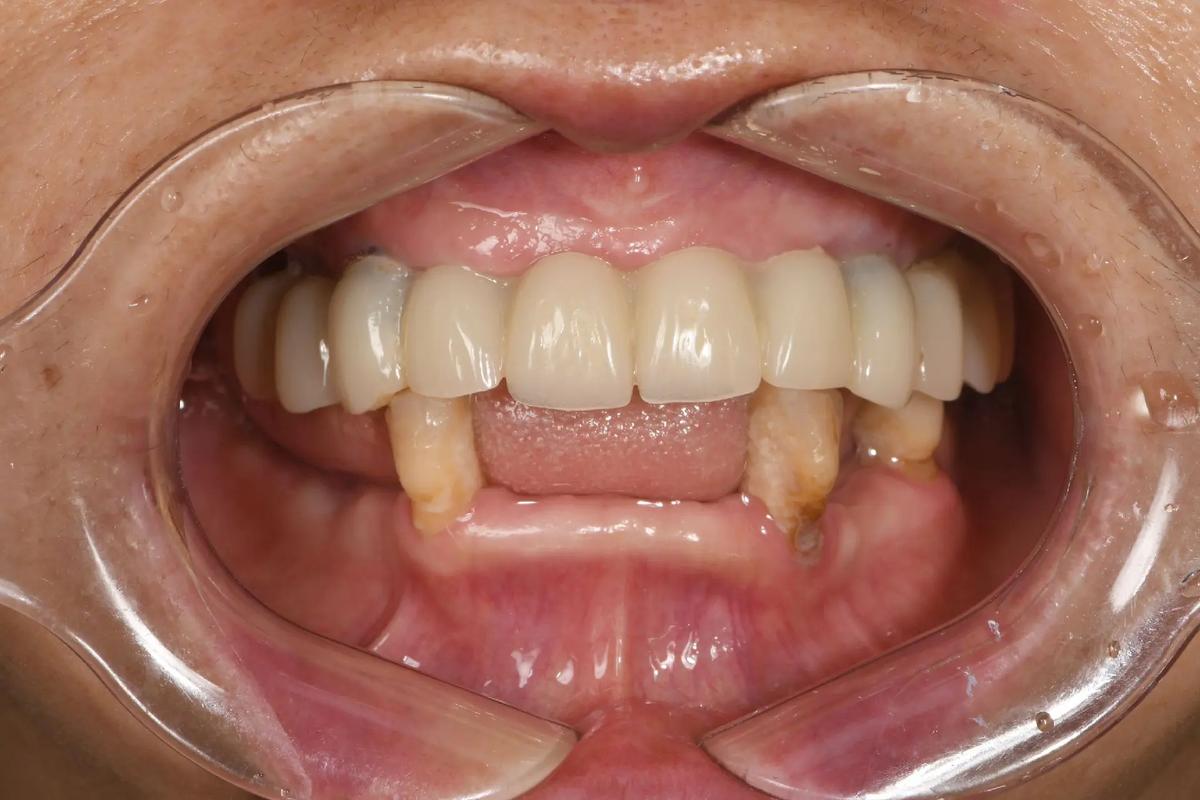 拜博口腔急拔急种牙-图3 拜博口腔急拔急种牙-图3