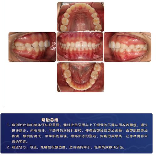安氏二类错颌矫正方法-图1