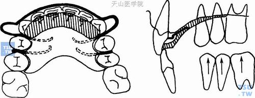 正畸双曲舌簧弯制方法-图3 正畸双曲舌簧弯制方法-图3