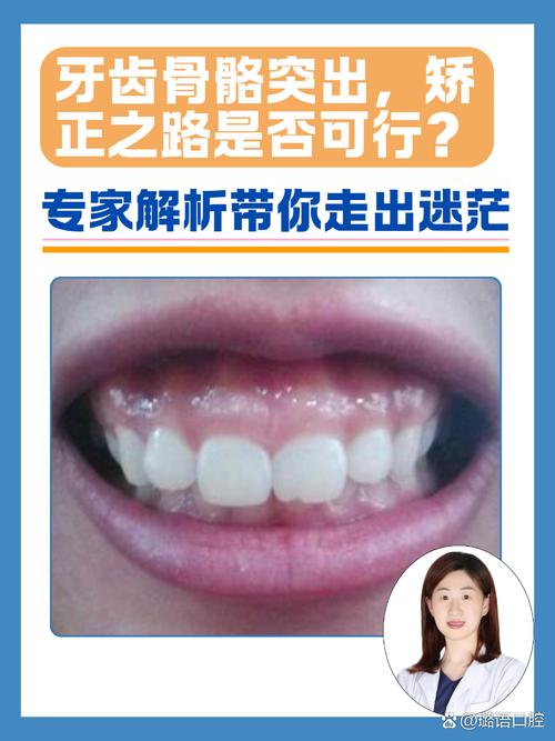 正畸时骨头也凸怎么办-图1 正畸时骨头也凸怎么办-图1