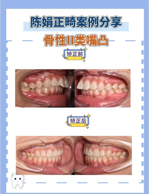 正畸时骨头也凸怎么办-图2