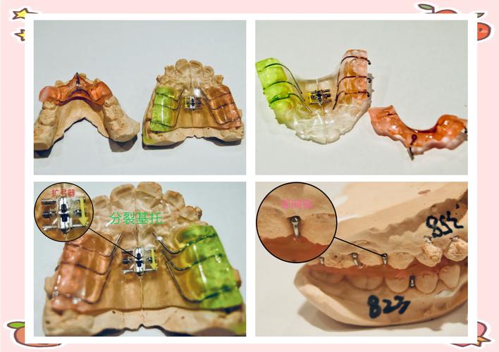 矫正器包含在正畸里吗-图1 矫正器包含在正畸里吗-图1