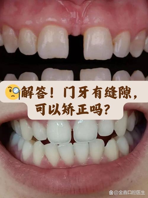 大门牙有缝矫正正畸大概需要花多少钱呢？-图2