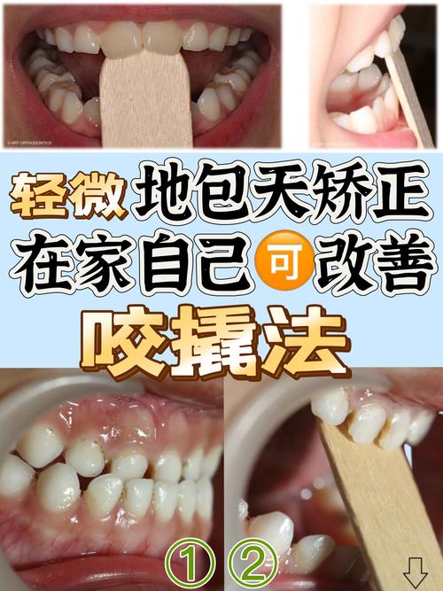 地包天矫正最快方法是什么？30天见效可行吗？-图2
