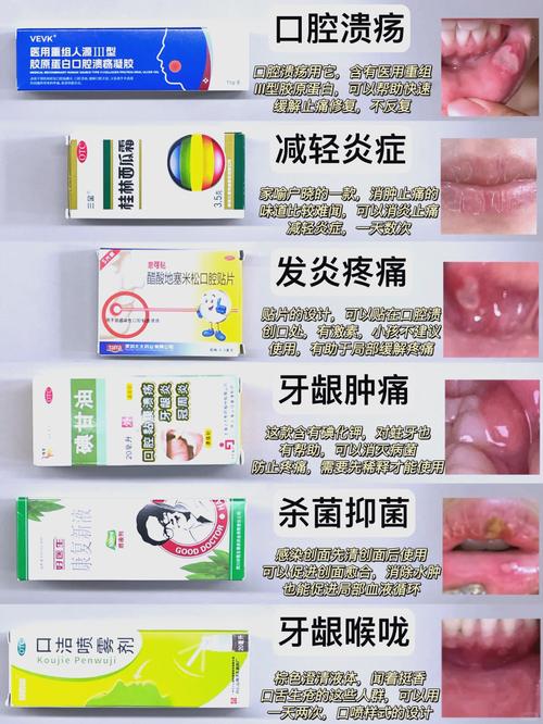 口腔溃疡反复发作总不好怎么办?快速有效治疗方法有哪些?-图1 口腔溃疡反复发作总不好怎么办?快速有效治疗方法有哪些?-图1