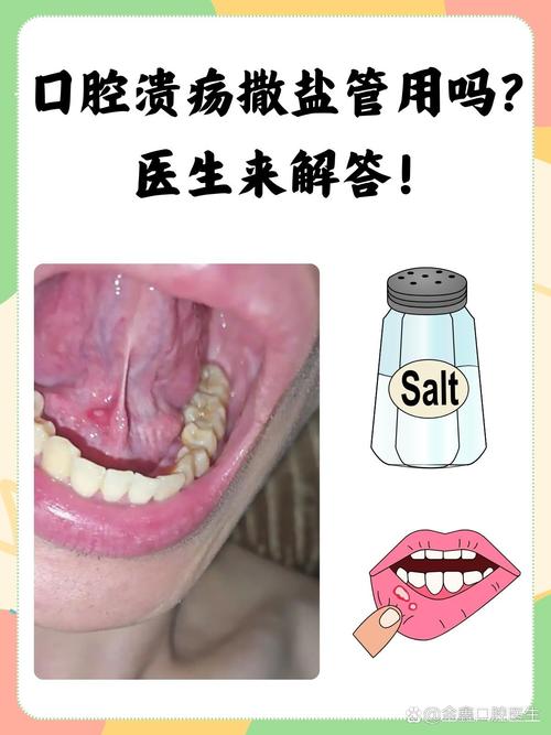 口腔溃疡反复发作总不好怎么办？快速有效治疗方法有哪些？-图2