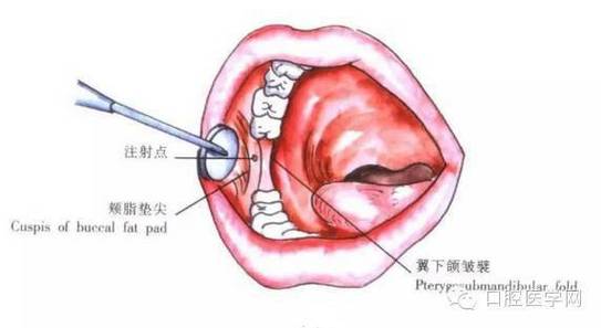 口腔局部麻醉的方法有-图2 口腔局部麻醉的方法有-图2