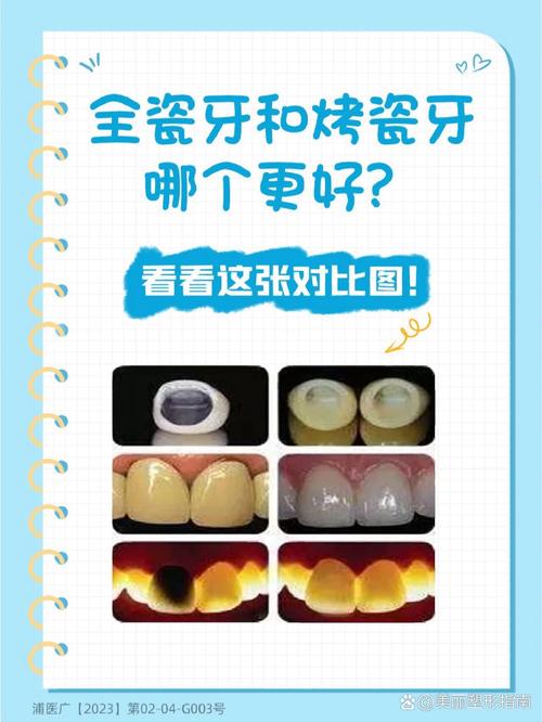 种牙与烤瓷牙的差别具体体现在哪?哪种更适合修复牙齿?-图2 种牙与烤瓷牙的差别具体体现在哪?哪种更适合修复牙齿?-图2