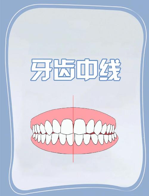 牙齿中线不齐有哪些调整方法?哪种最有效?-图3 牙齿中线不齐有哪些调整方法?哪种最有效?-图3