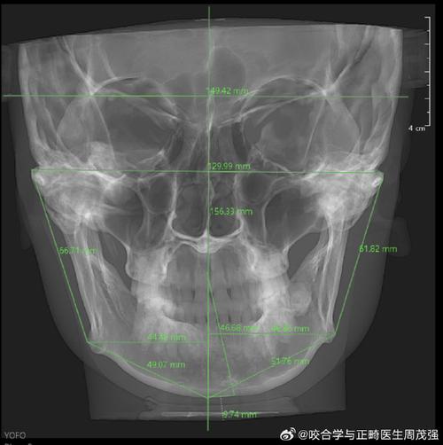 颞下颌关节盘前移正畸-图1 颞下颌关节盘前移正畸-图1