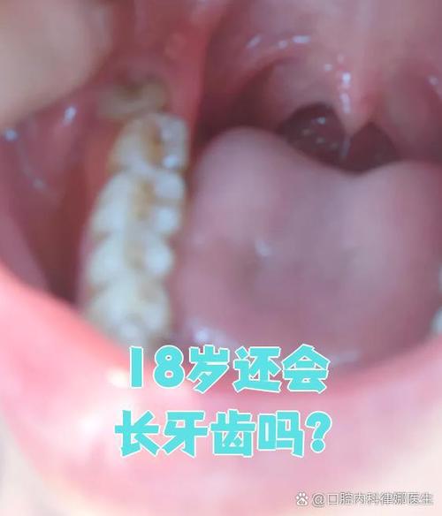 十八岁以前能种牙吗-图2 十八岁以前能种牙吗-图2