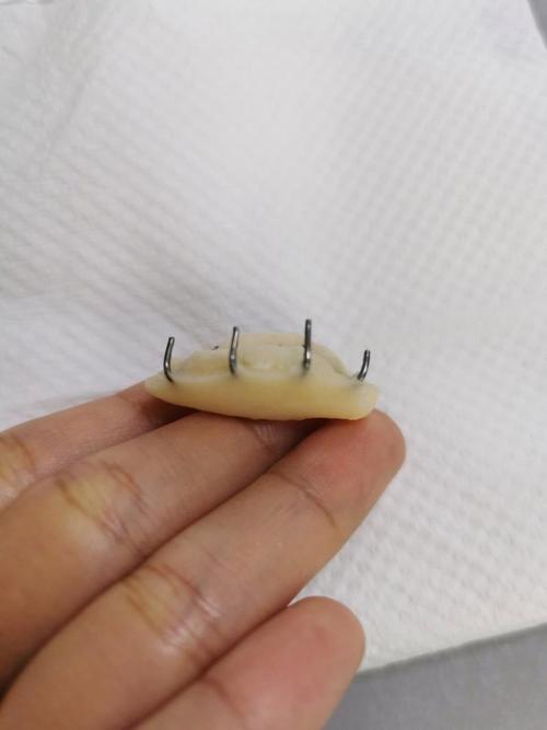 正畸树脂平导有什么用-图1 正畸树脂平导有什么用-图1