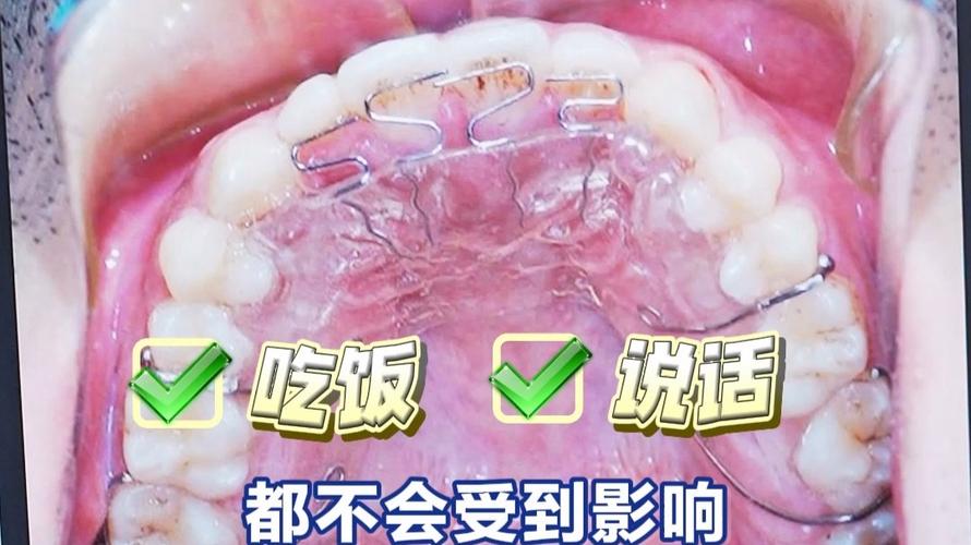 正畸反颌推簧的制作图-图2 正畸反颌推簧的制作图-图2