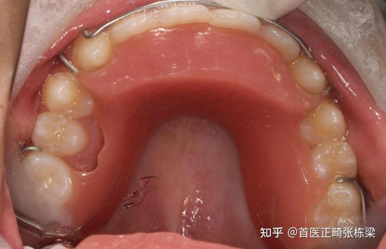 缺两个下颌侧切牙正畸能做吗?效果怎样?-图1 缺两个下颌侧切牙正畸能做吗?效果怎样?-图1